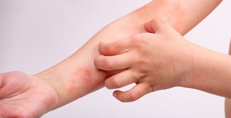 Fenomeno-flip-flop-transicao-entre-psoriase-e-dermatite-atopica-exige-reconhecimento-clinico