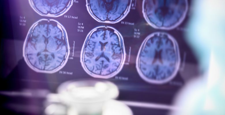 Investigadores alertam para perfil de risco de demência